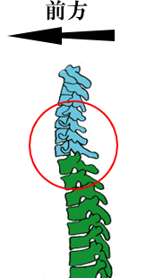 �X�g���[�g�l�b�N�̉���}�ł�